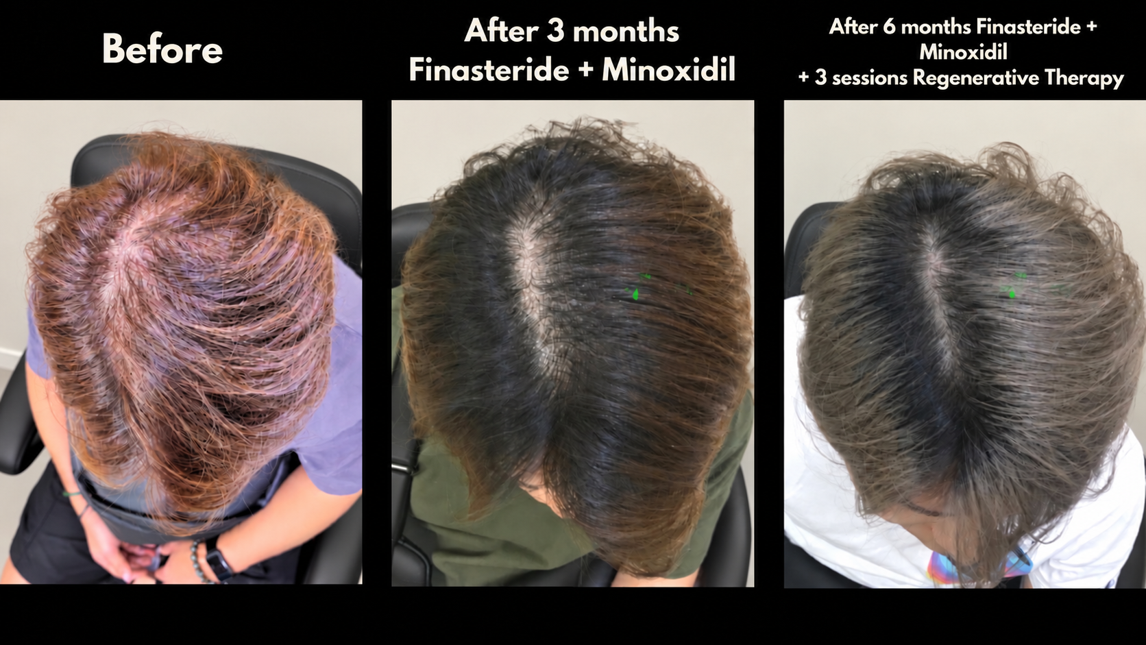 Before, after 3 months finasteride plus minoxidil, and after 6 months finasteride plus minoxidil plus 3 regenerative therapy sessions
