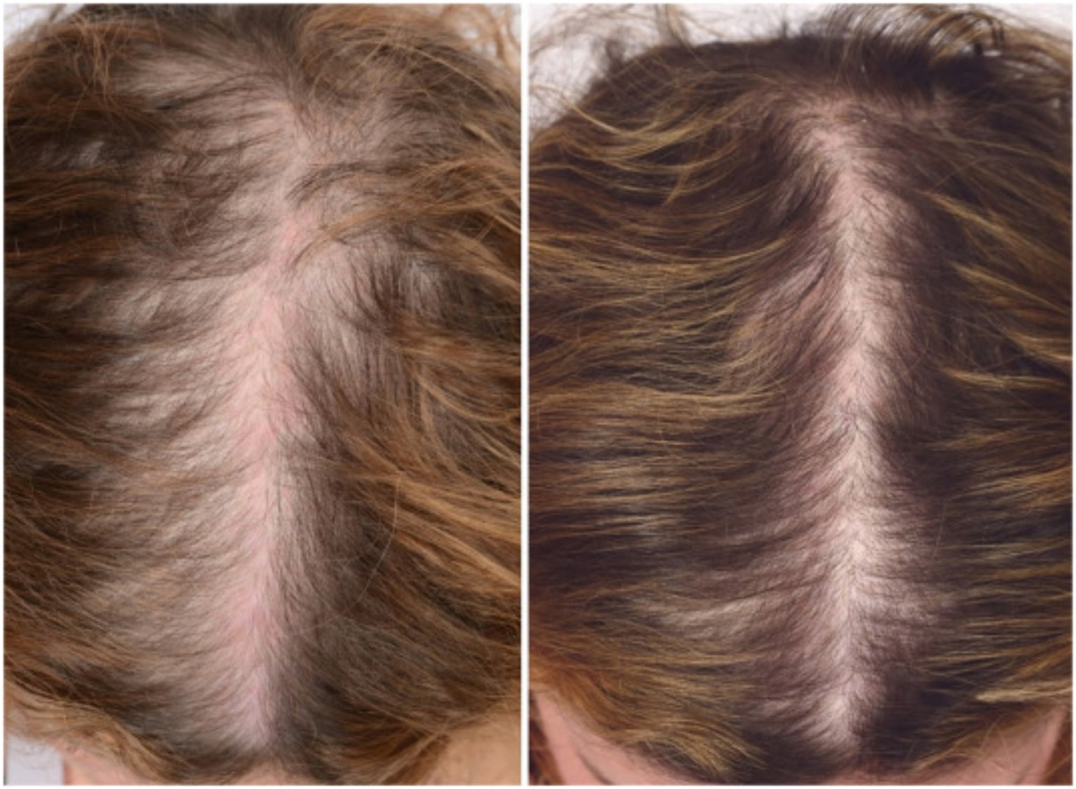 A 46-year-old woman with pattern hair loss, before and 3 months after 3 PRP sessions