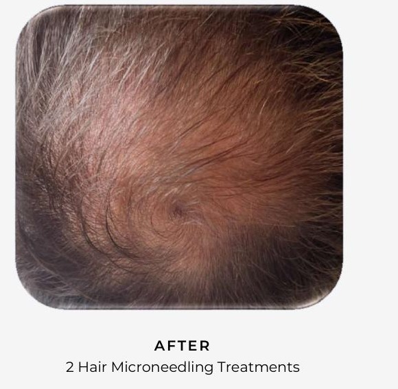 Crown area after 2 AnteAGE MD hair microneedling treatments