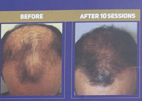 Crown and vertex of a man with advanced thinning before QR678 treatment, and the same area after 10 sessions
