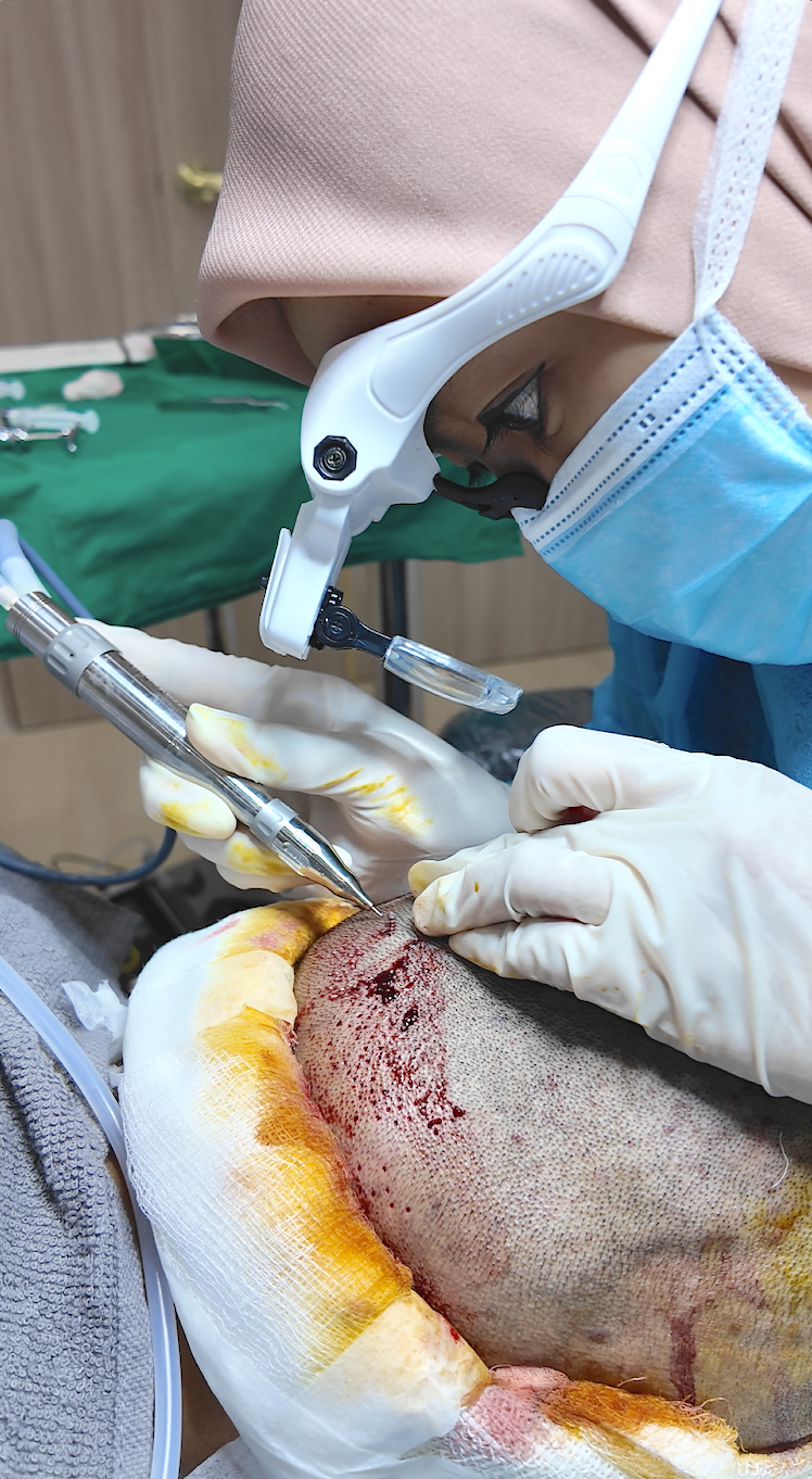 Dr Deena placing grafts with an implanter pen during an FUE hair transplant at Thrive Hair Clinic