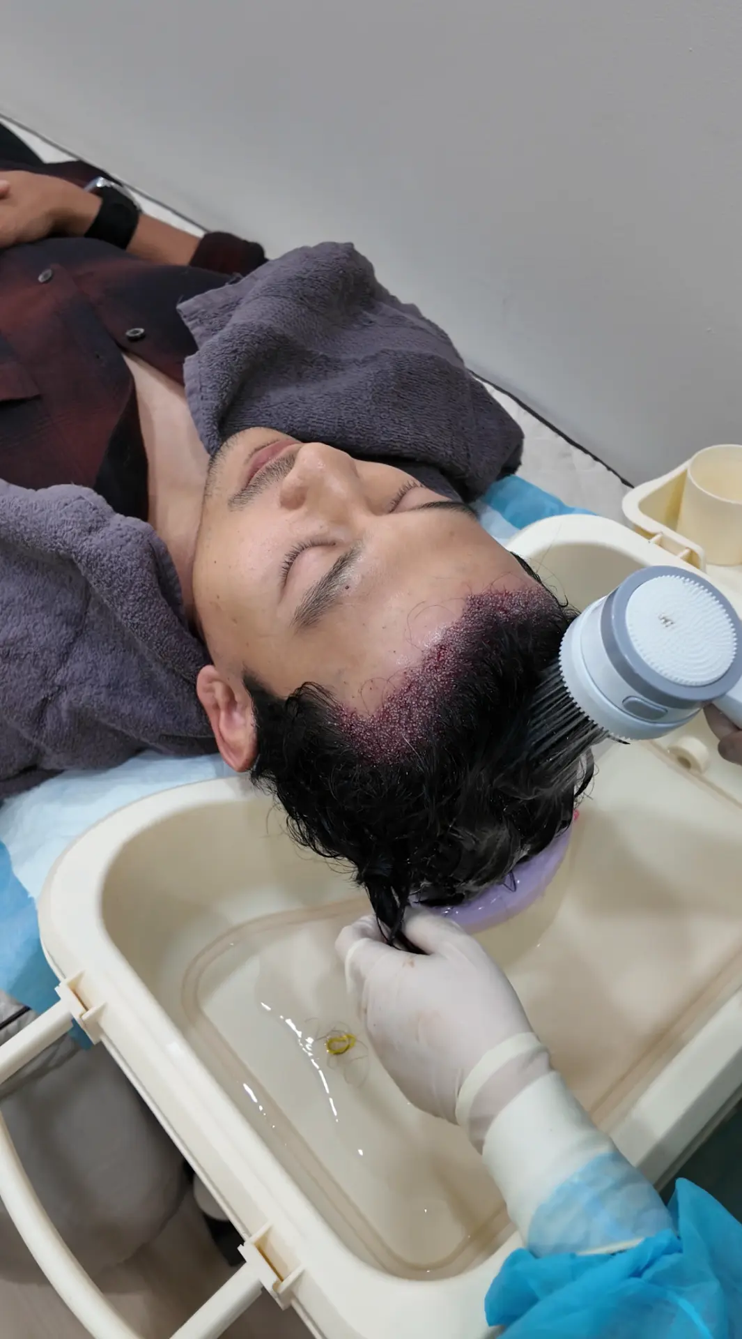 Gentle post-operative hair wash after a hair transplant at Thrive Hair Clinic