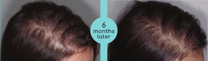Female scalp parting before and six months after treatment in the brochure