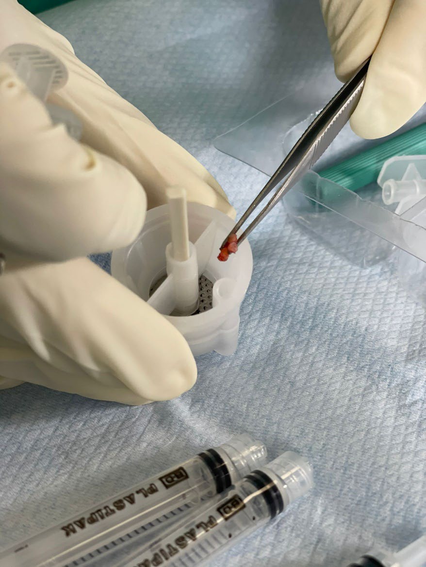 Scalp tissue samples placed into the Regenera processing cartridge