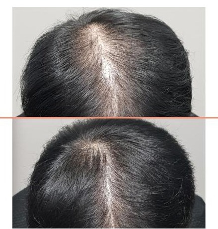 Crown parting of a man before treatment, and the same crown three months after the AMT procedure