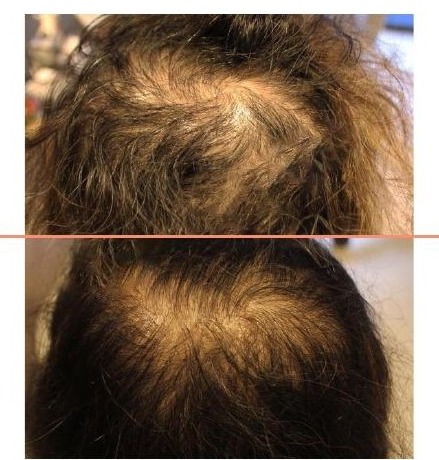Crown of a woman before treatment, and the same crown one year after the AMT procedure