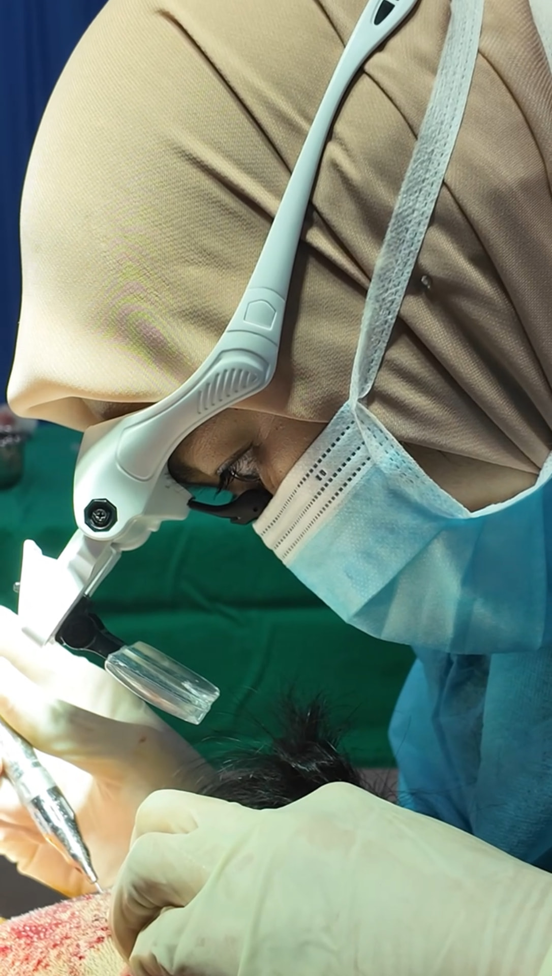 Thrive surgeon performing FUE extraction under magnification loupes