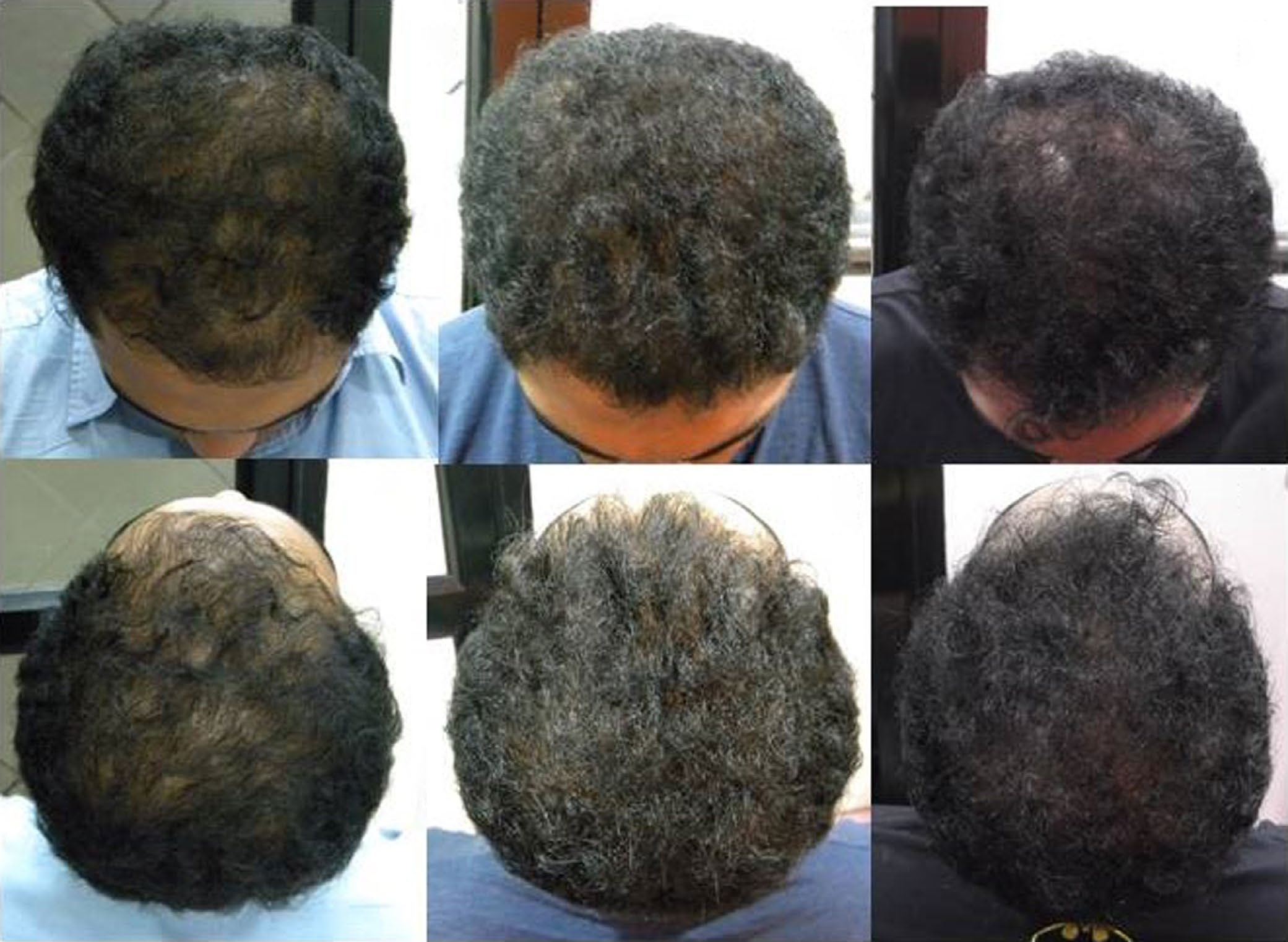 Six clinical photographs of one man's scalp from above and behind at three time points during the QR678 arm of the trial