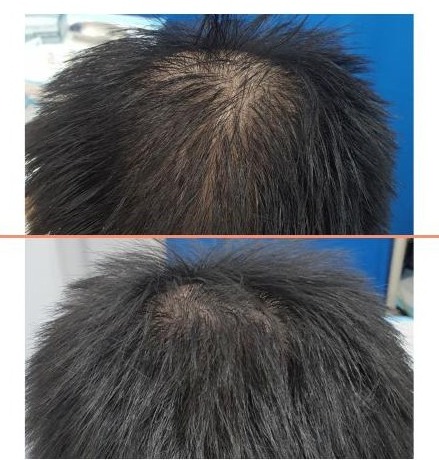 Top of the head of a man before treatment, and the same view two months after the AMT procedure