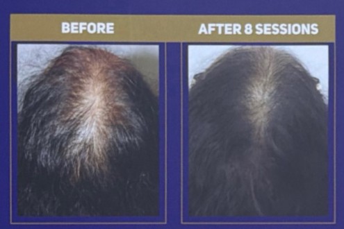 Mid-scalp parting of a woman with thinning before QR678 treatment, and the same parting after 8 sessions