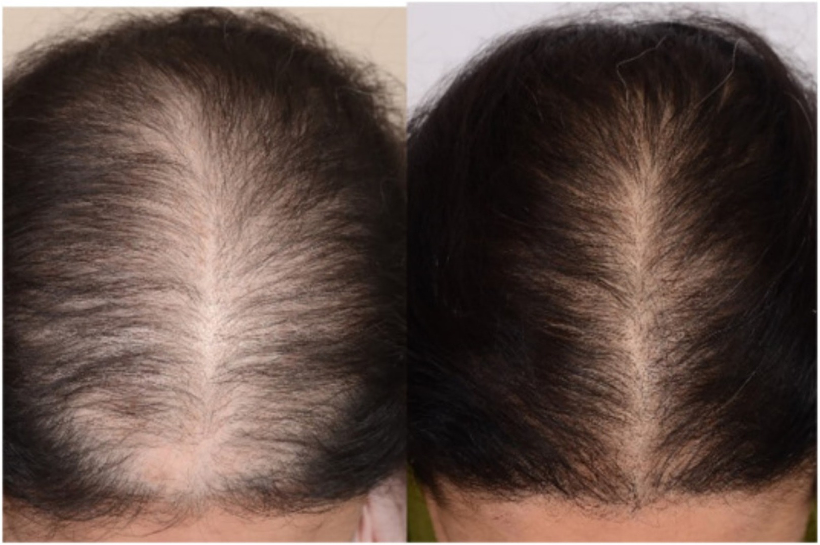 A 31-year-old woman with pattern hair loss, before and 4 months after 5 PRP sessions
