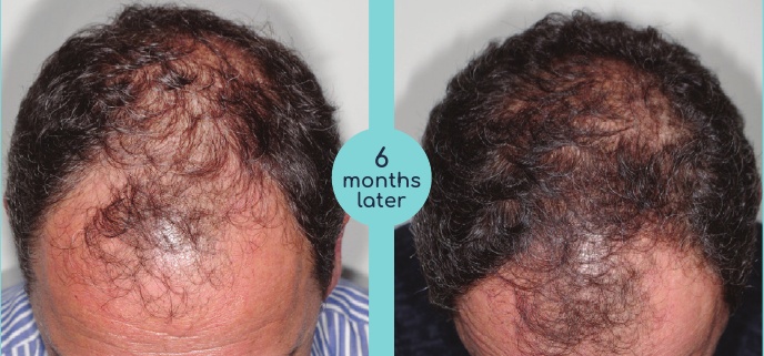 Male scalp before and six months after treatment in the patient brochure