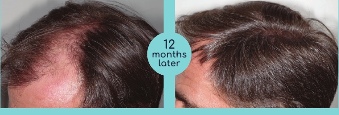 Hairline before and twelve months after treatment in the brochure