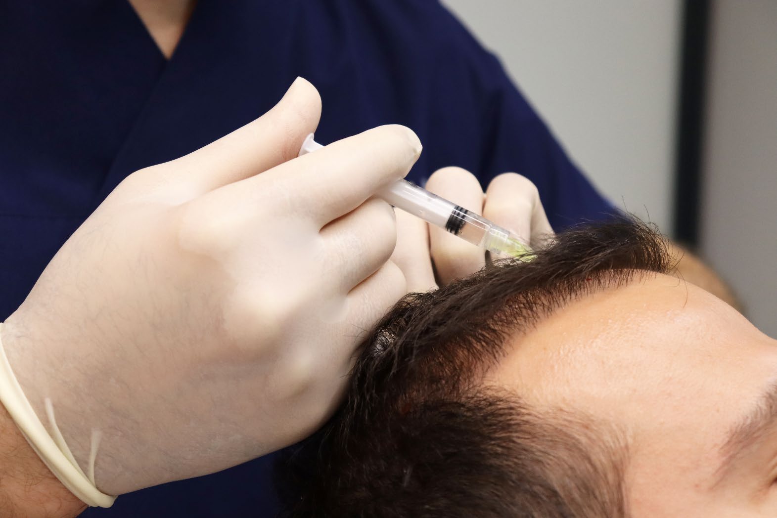 Doctor injecting a micrograft suspension into a thinning scalp