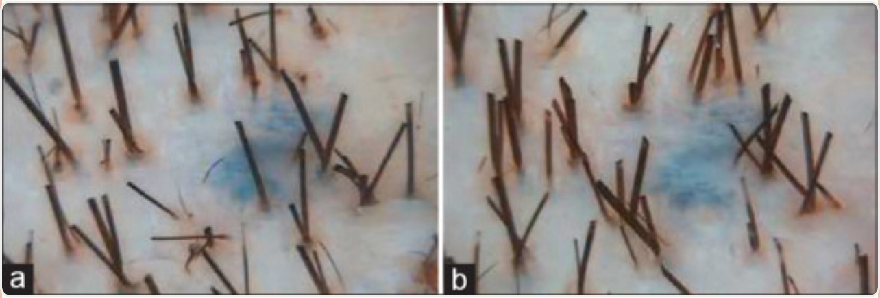 Phototrichogram before and after PRP injections alone