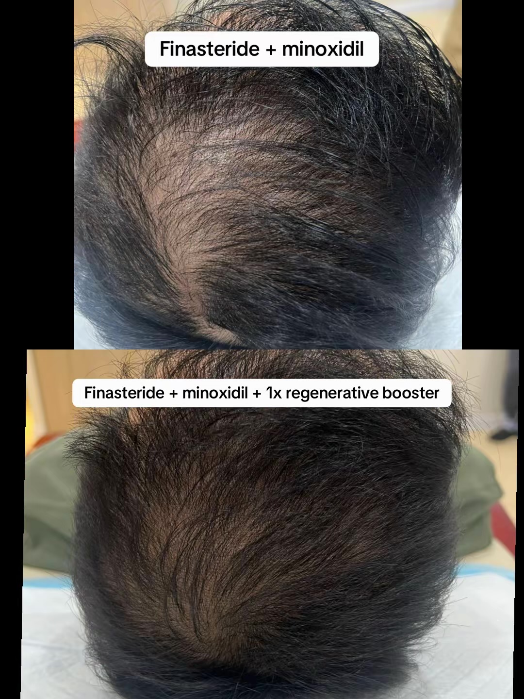 Finasteride and minoxidil foundation therapy alone, then the same foundation plus one regenerative booster session