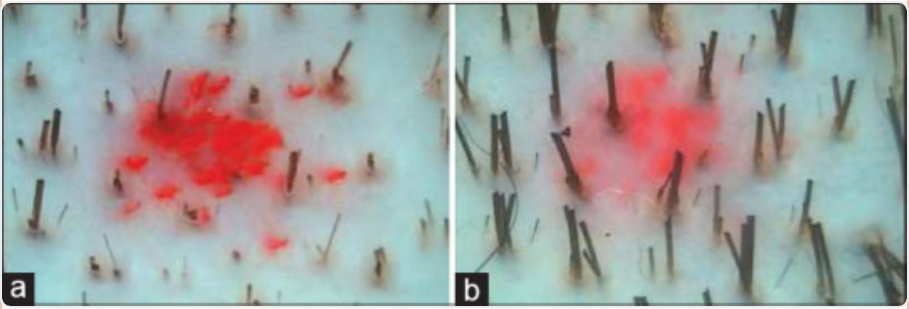 Phototrichogram before and after combined 5% minoxidil and PRP treatment