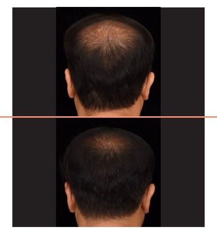 Back of the head of a man before treatment, and the same view three months after the AMT procedure