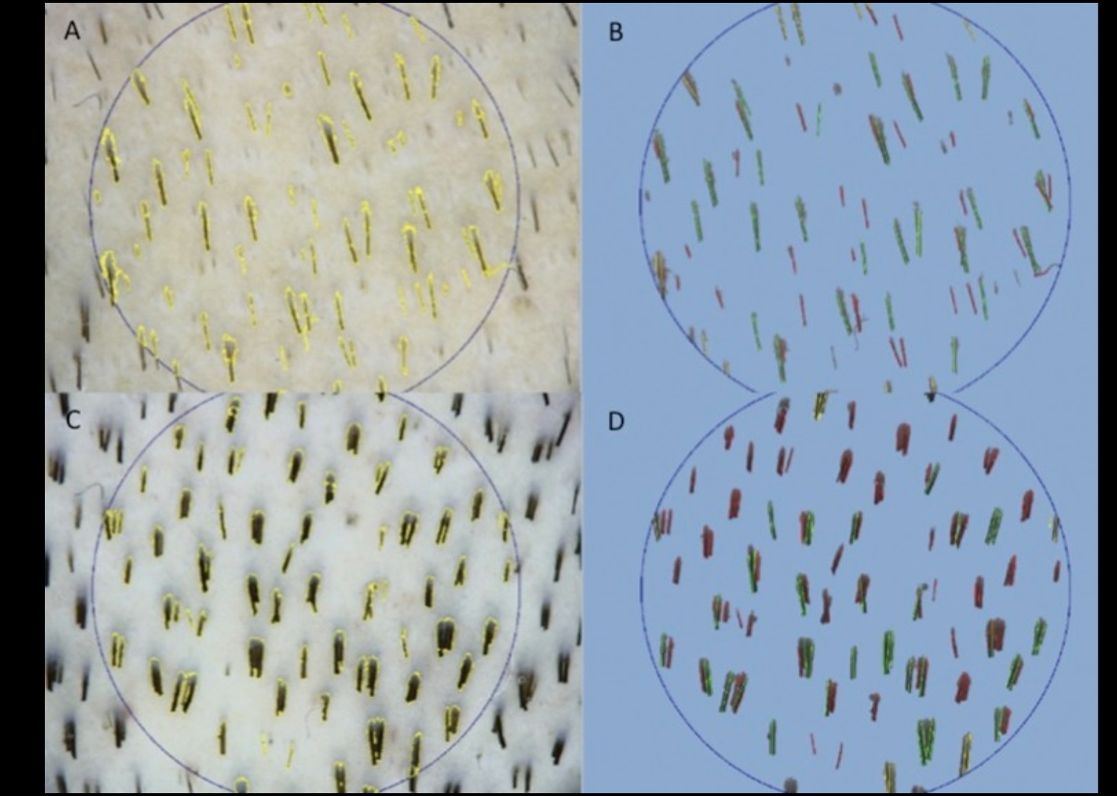 Trichoscan digital image analysis before and after PRP in the Gentile 2015 study