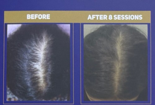 Mid-scalp parting of a woman with diffuse thinning before QR678 treatment, and the same parting after 8 sessions