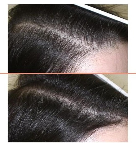 Front hairline parting of a woman before treatment, and the same parting three months after the AMT procedure