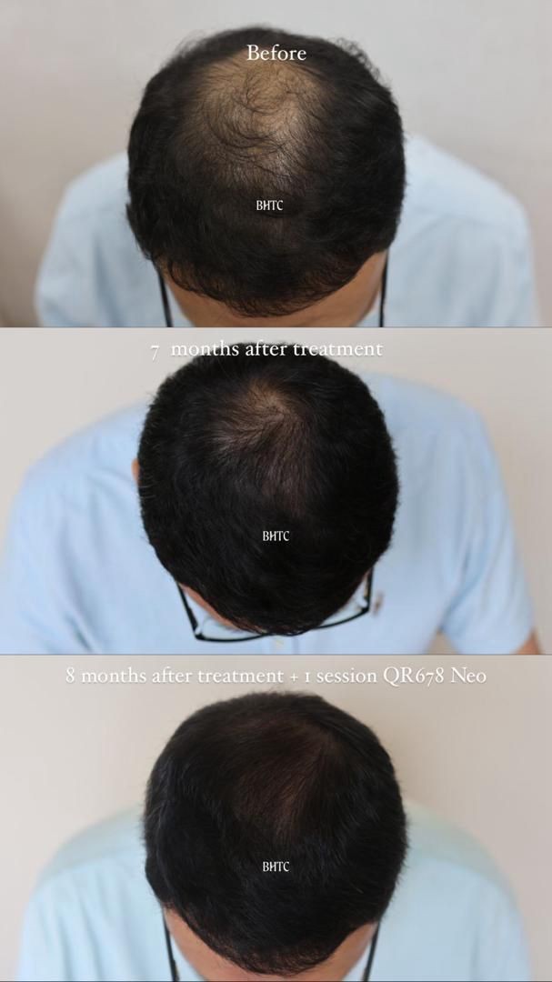 Three-part series of one patient's crown: before treatment, 7 months after treatment, and 8 months after treatment plus one session of QR678 Neo