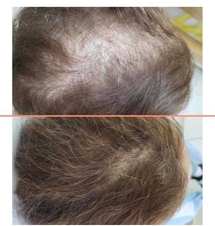 Diffuse thinning across the crown of a woman before treatment, and the same crown six months after the AMT procedure