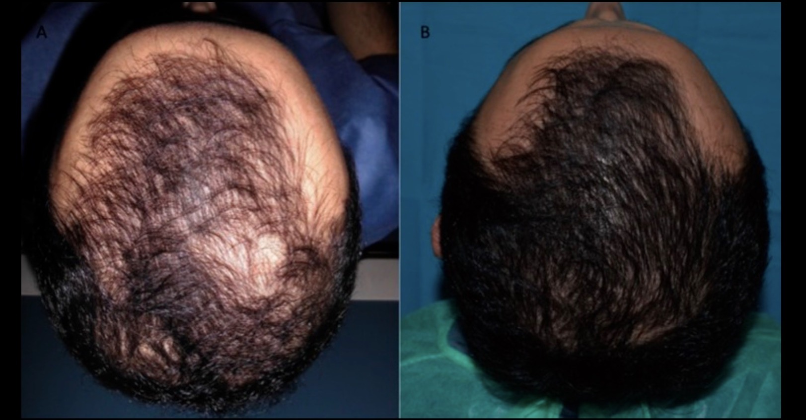 A 29-year-old man with pattern hair loss before, and 2 weeks after his last PRP treatment