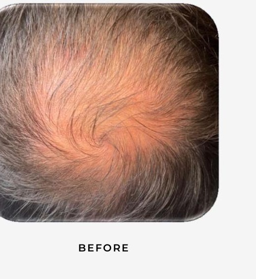 Crown area with diffuse thinning before AnteAGE MD treatment