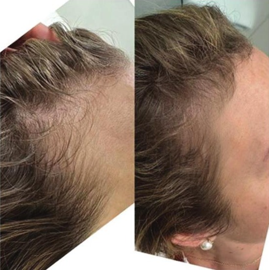 Temple and side of a woman's scalp before treatment, and the same area after three treatments