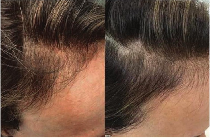 Temple and parting of a woman with thinning before treatment, and the same area after three treatments