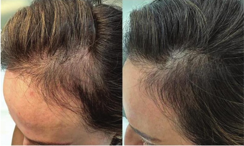 Hairline and temple of a woman with thinning before Labossen Bio-Xome Hair treatment, and the same area after three treatments
