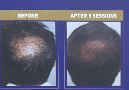 Crown of a man with thinning before QR678 treatment, and the same crown after 5 sessions