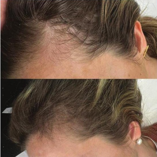 Hairline of a woman before treatment, and the same hairline after three treatments