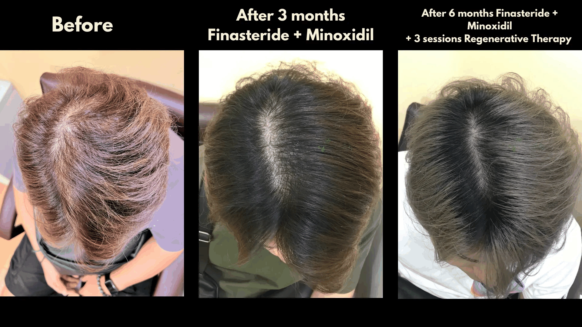 Hair progression before treatment, after three months of finasteride and minoxidil, and after six months with three regenerative sessions added