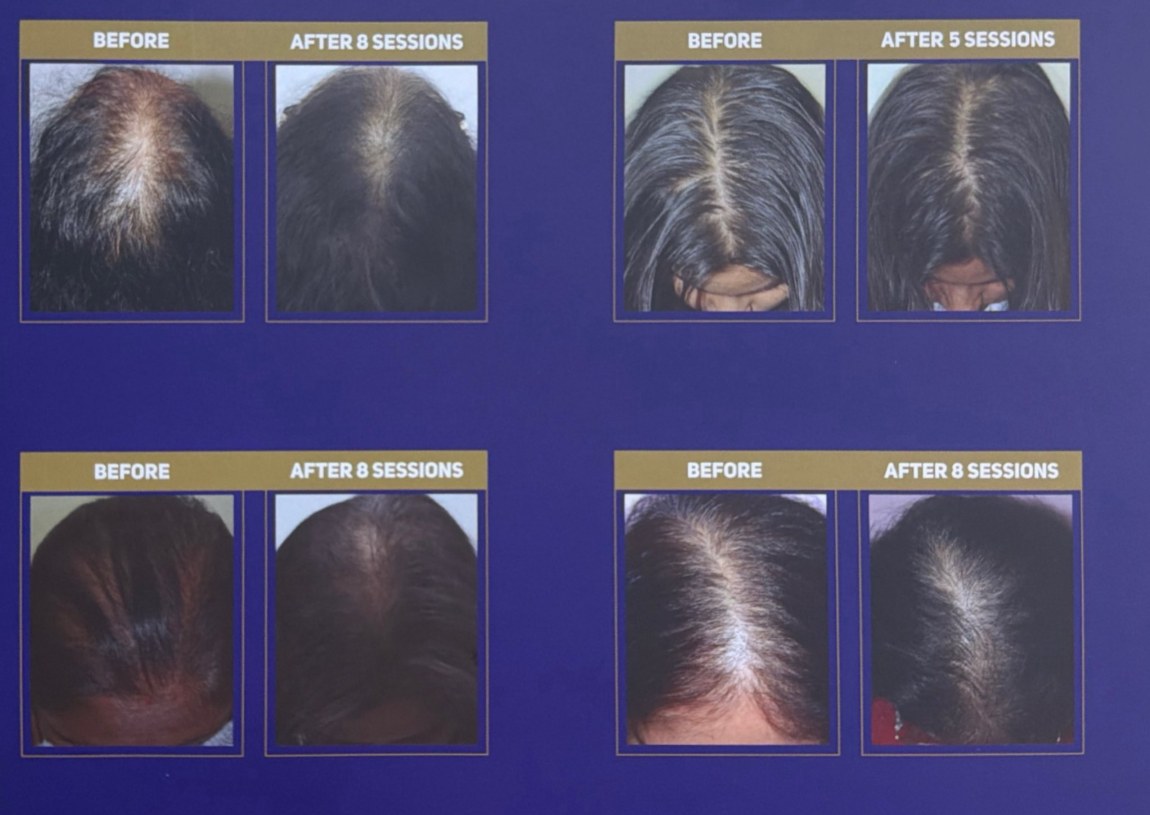Female before-and-after clinical comparisons after eight sessions