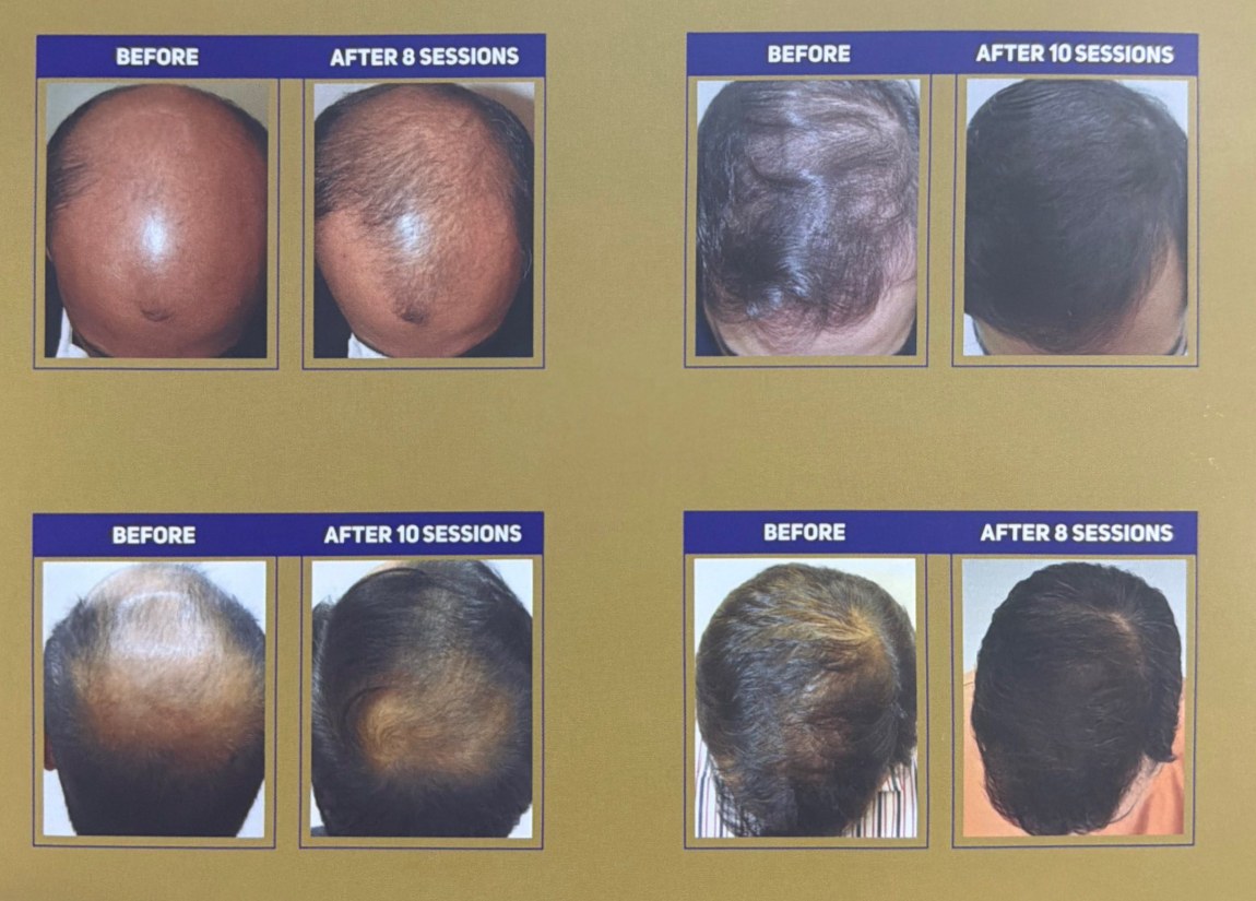 Male before-and-after clinical comparisons after five to ten sessions