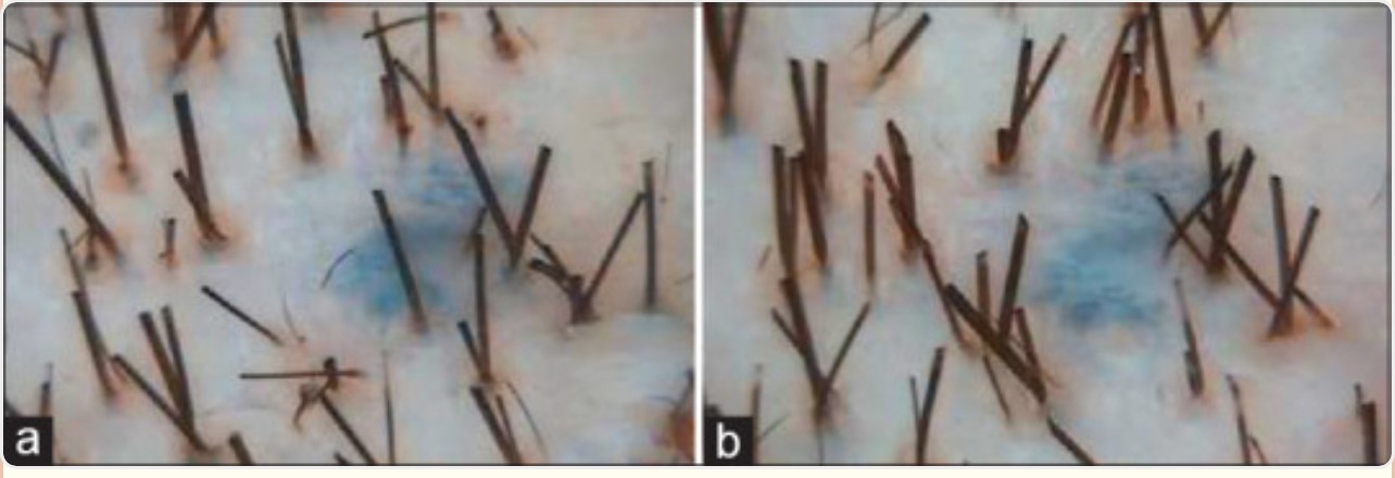 Published phototrichogram before and after platelet-rich plasma treatment
